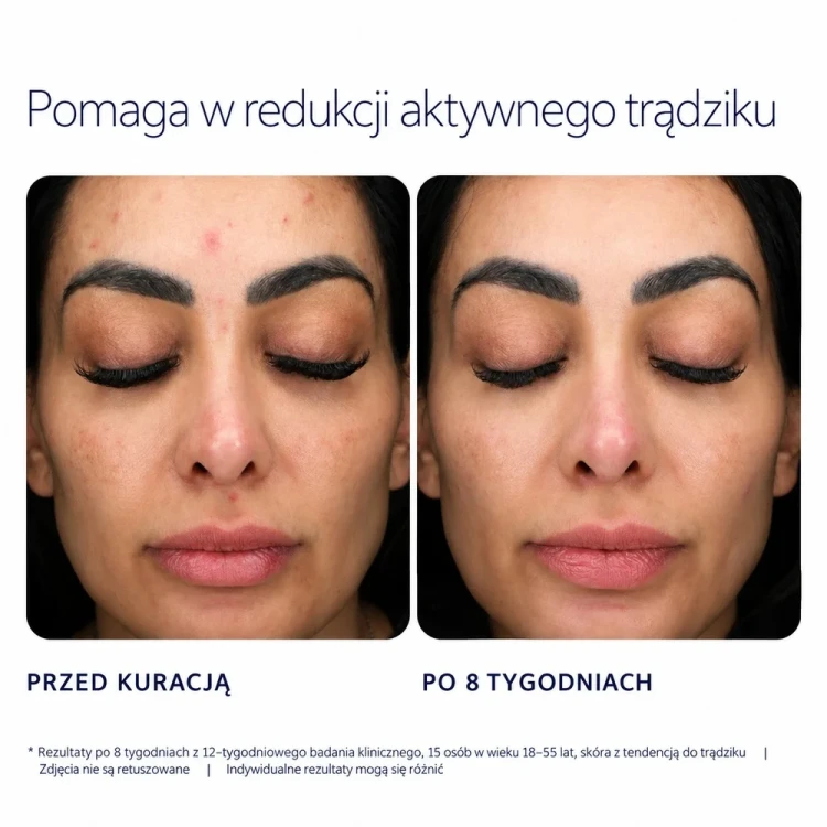 Redukcja_tradziku_przed_i_poPcaSkin.webp